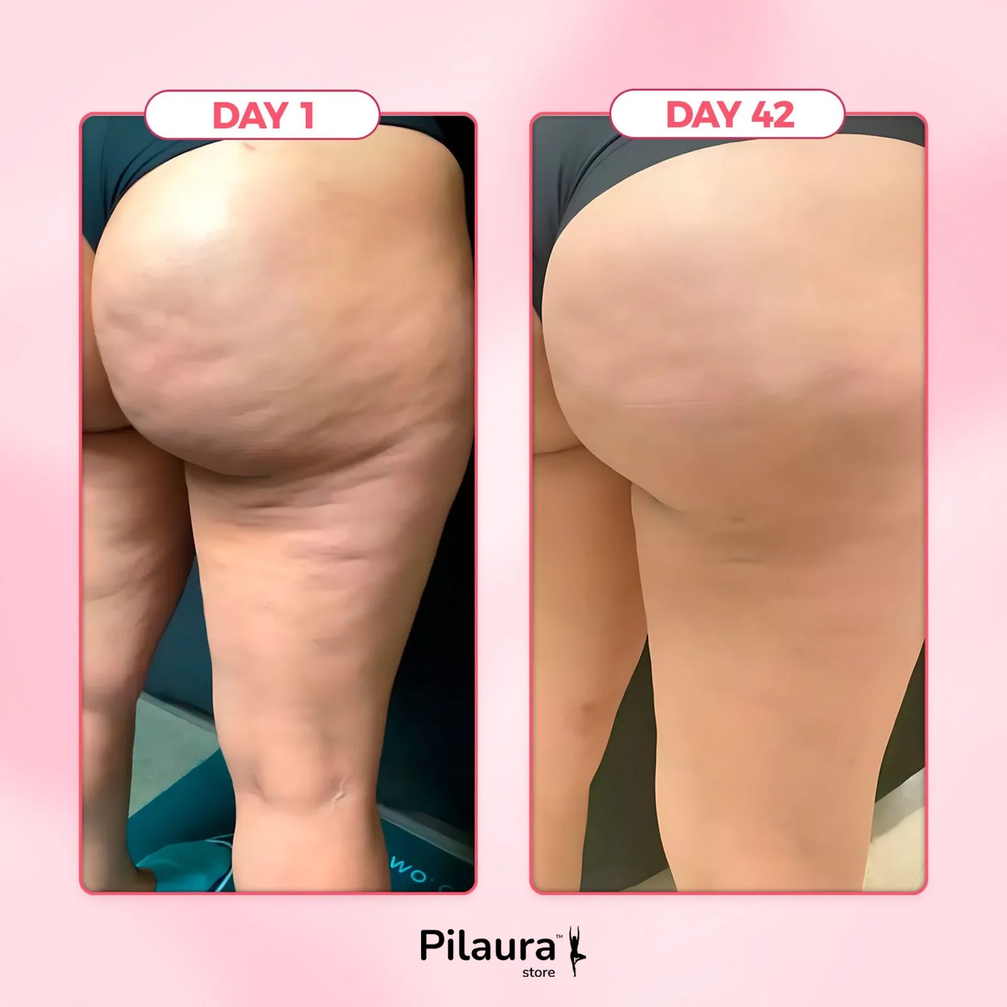 Pilaura™ Cellulite Relief Kit 2