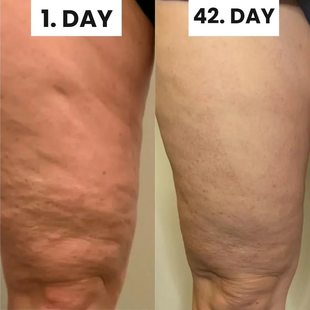 Pilaura™ Cellulite Relief Kit 2